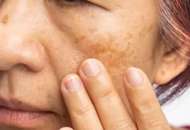 Pigmentation Treatments