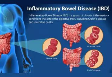 Inflammatory Bowel Diseases (IBD)