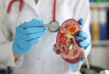 Kidney Stone Management image